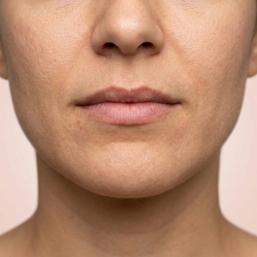 Illustration : lèvres fines, contour peu dessiné, avant injection